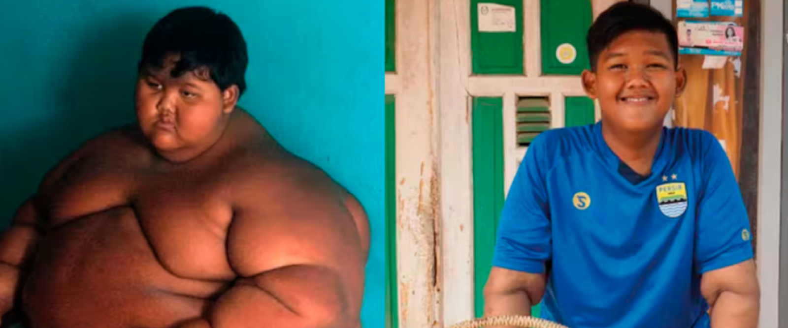 Indonesia: El cambio físico del niño que fue catalogado como el más gordo del mundo
